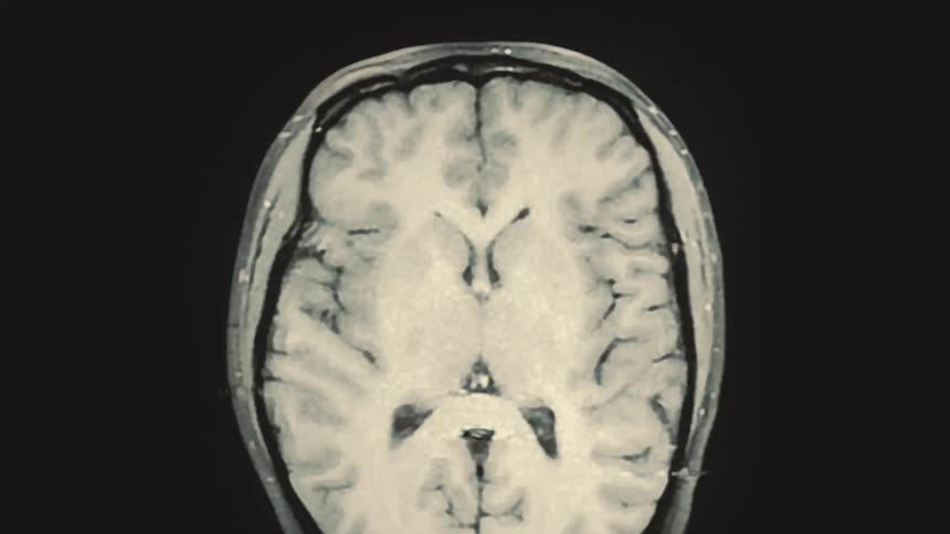 A dynamic medical animation created from a series of flashing MRI scans showing cross-sections of a human head and brain