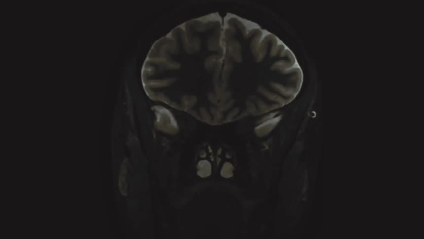 A chaotic montage of vintage-style MRI scans showing different cross-sections of a human brain and skull