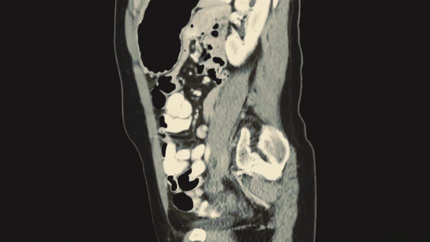 Sagittal view of a CT scan showing the organs and spine within the human abdomen and pelvis
