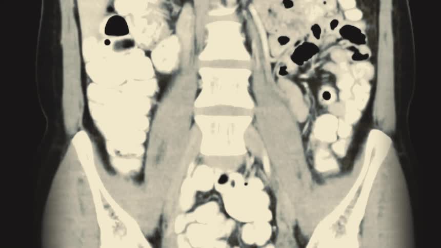 A medical animation showing a coronal view of a CT scan of a human abdomen, revealing internal organs, intestines, and spine