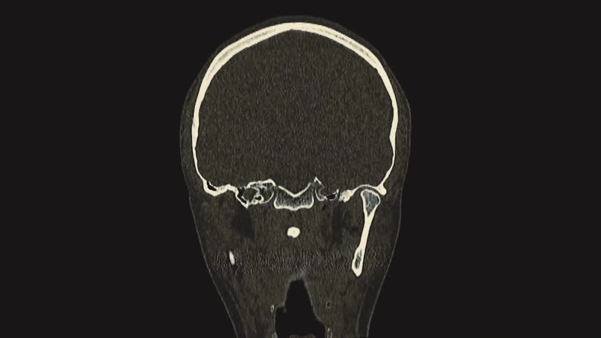 Coronal view of a human skull CT scan animation revealing the internal bone structures
