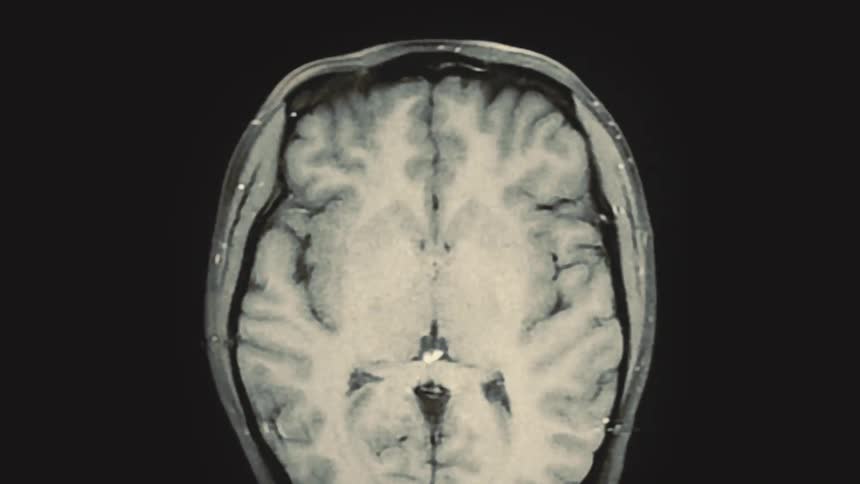 An animated montage of flickering MRI brain scans reveals different cross-sections of a human head