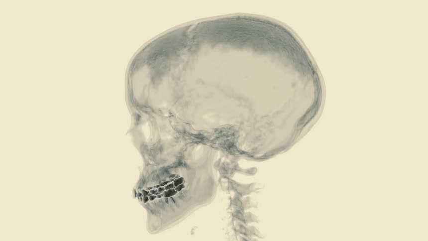 Stylized medical X-ray animation of a human skull and upper spine rotating 360 degrees against a sepia background