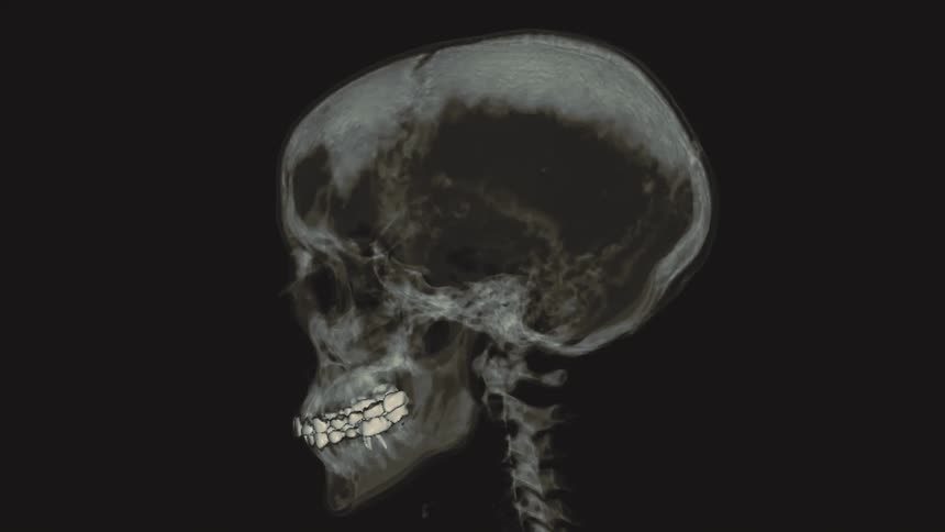 A volumetric rendering of a human skull from a CT scan rotates 360 degrees on a black background, showcasing anatomical detail
