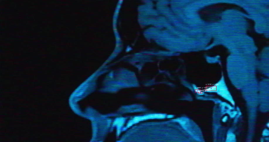 A detailed MRI scan of a human head is analyzed by advanced diagnostic software with glowing blue data overlays