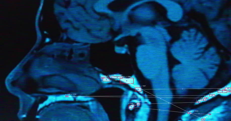 A computer program analyzes a medical MRI of a human head with facial recognition and data mapping technology