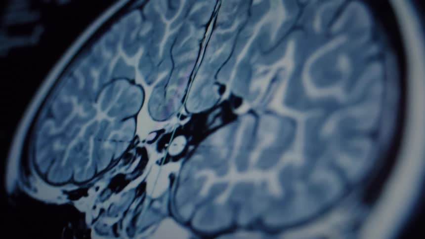 A detailed close-up of a human brain MRI scan on a screen reveals the intricate structures for medical analysis