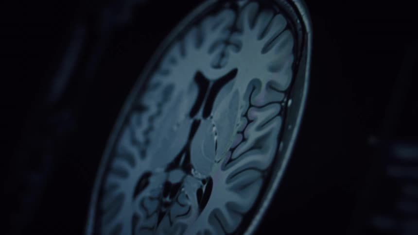 A detailed view of an MRI scan animating through different cross-sections of the human brain
