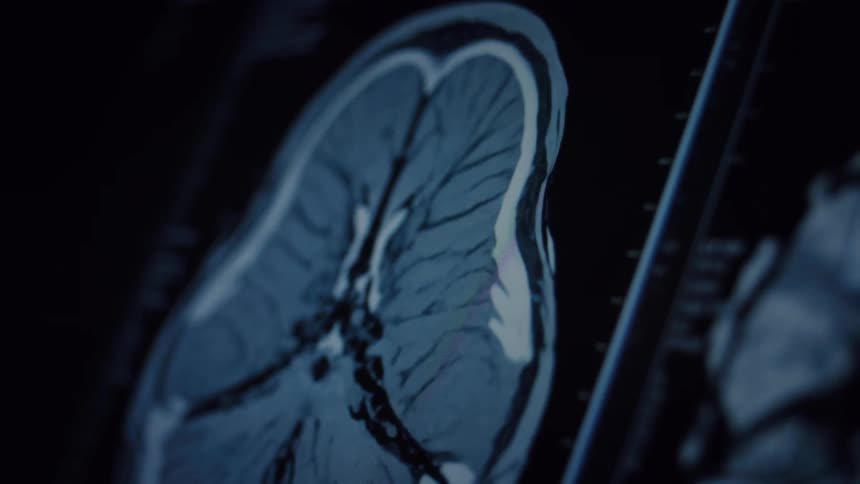 Close-up shot of a magnetic resonance imaging (MRI) scan of a human brain on a monitor