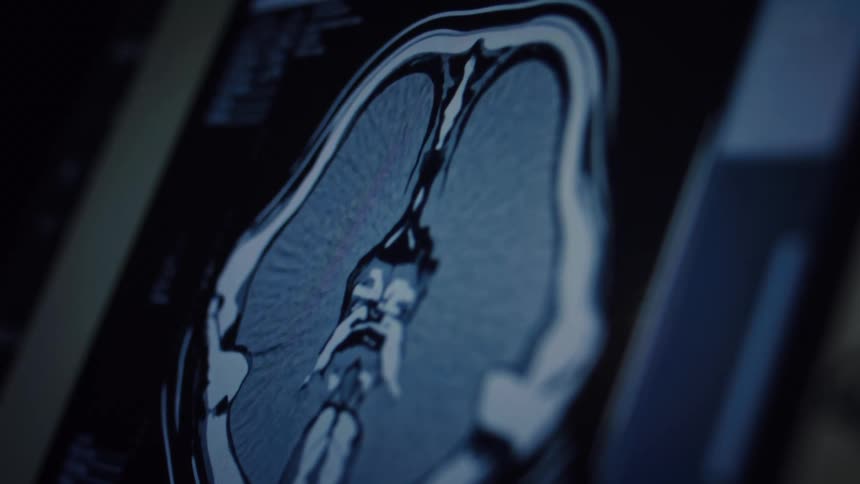 A detailed close-up of a CT scan showing a cross-section of a human brain on a computer monitor