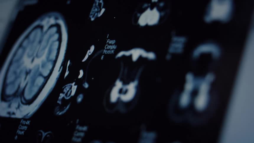 A close-up shot of an MRI brain scan with a slow rack focus revealing different cross-sections