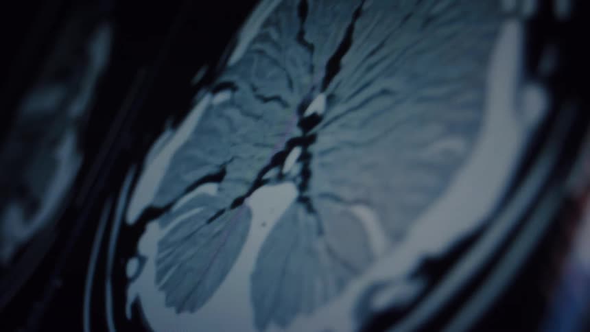 A close-up rack focus shot of a human brain MRI scan on a computer monitor