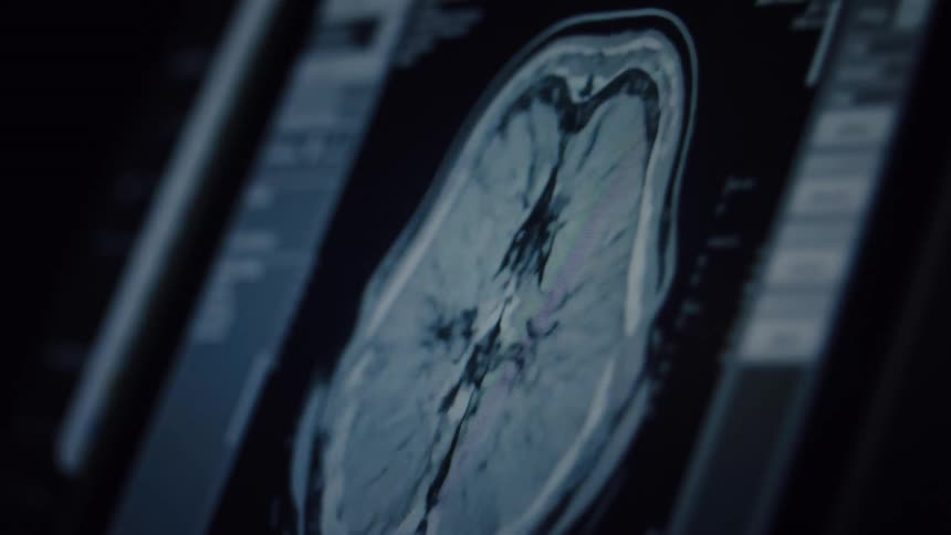 A close-up, angled view of an MRI brain scan cycling through different layers on a medical monitor