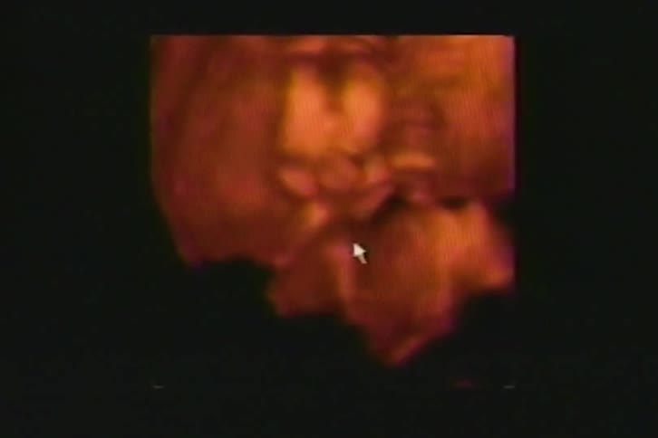 A split-screen view shows both a 2D and a detailed 3D/4D color ultrasound of an unborn baby's face on a monitor