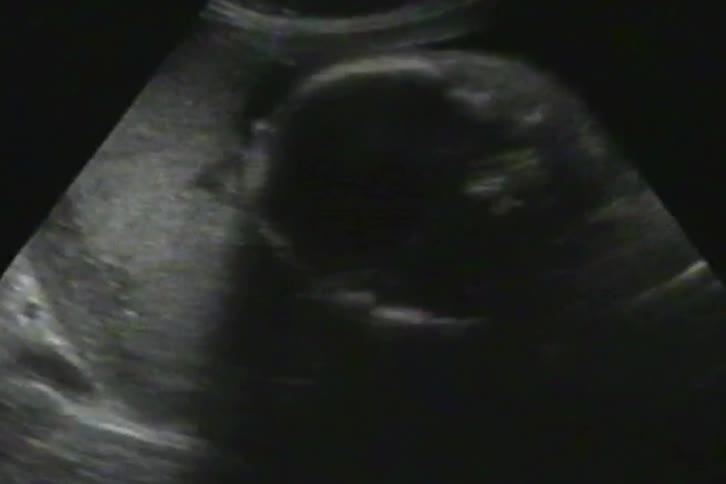 A black and white ultrasound scan shows a close-up of a developing fetus moving inside the womb