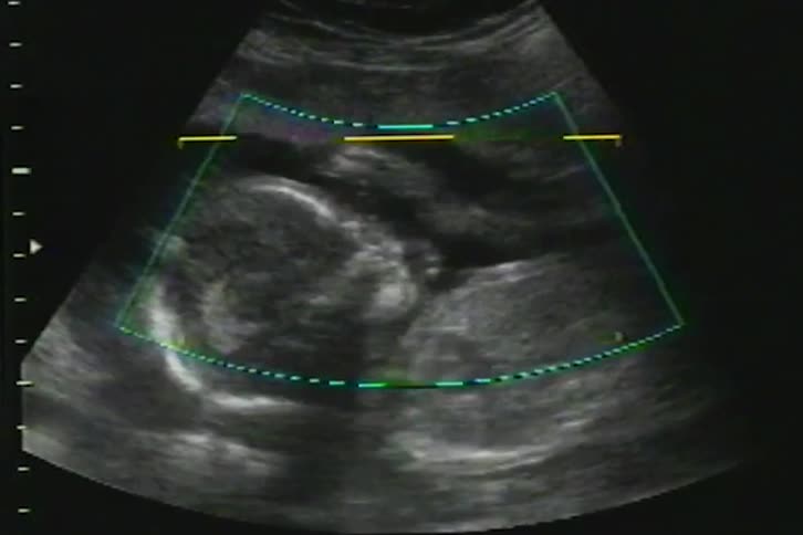 A prenatal ultrasound scan reveals the detailed profile of a developing fetus inside the womb