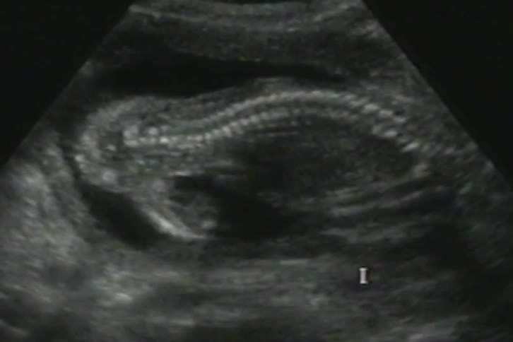Medical ultrasound reveals the developing spine of a fetus during a prenatal scan