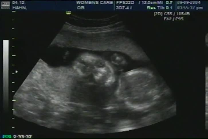 A prenatal ultrasound reveals a developing fetus moving inside the womb during a medical examination
