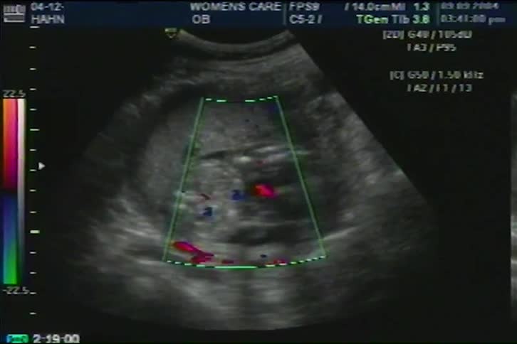 A color Doppler ultrasound provides a detailed view of blood flow within a developing fetus in the womb