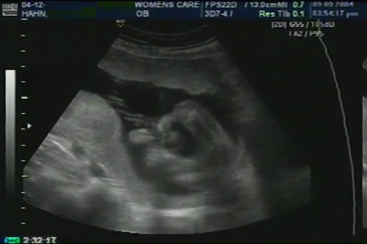 An authentic prenatal ultrasound scan shows a baby moving and developing inside the mother's womb