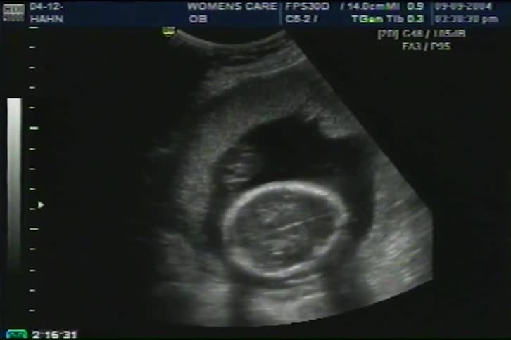 A medical ultrasound provides a first glimpse of a developing fetus moving within the womb