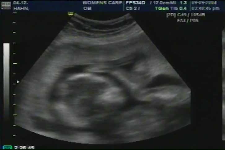 Medical imaging reveals a developing fetus during a routine obstetric ultrasound examination