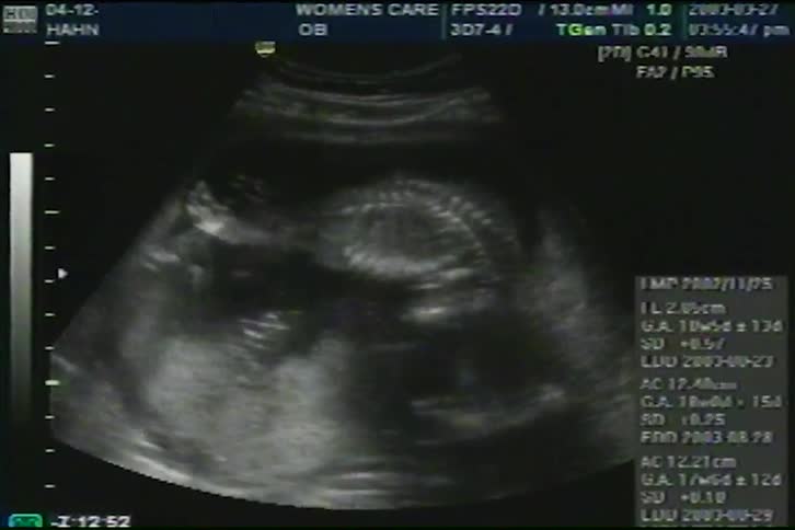 A medical ultrasound from 2003 shows a developing fetus moving inside the womb, highlighting the spinal column