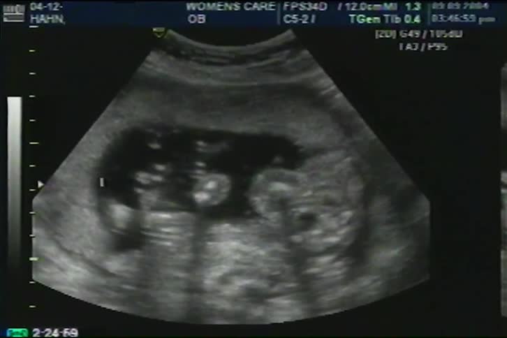A prenatal ultrasound reveals a developing fetus moving within the womb, with a close-up identifying the baby's foot