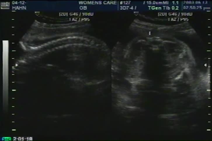 A doctor examines a fetus in the womb using a dual-screen ultrasound, labeling the spine and kidneys