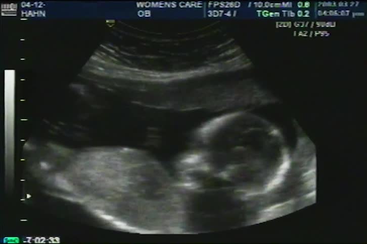 A close-up view of a prenatal ultrasound scan showing the profile and development of a fetus in the womb