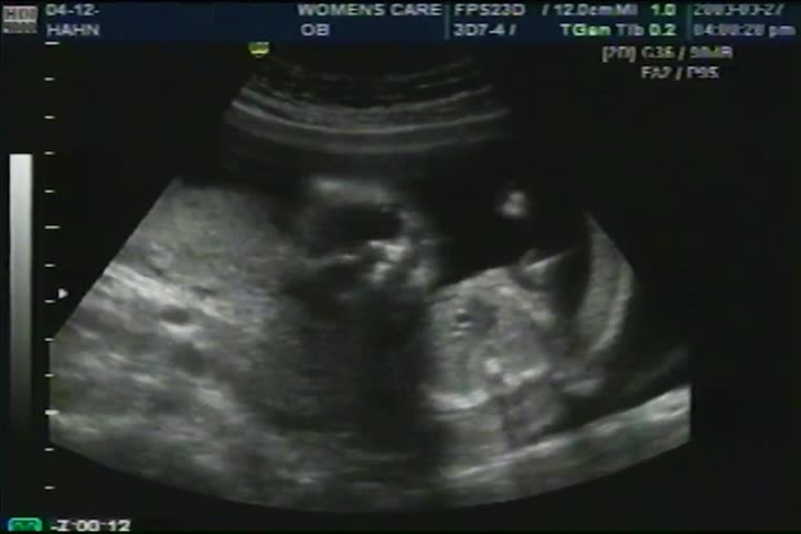 A detailed black and white ultrasound scan reveals a baby's face and body moving in the womb
