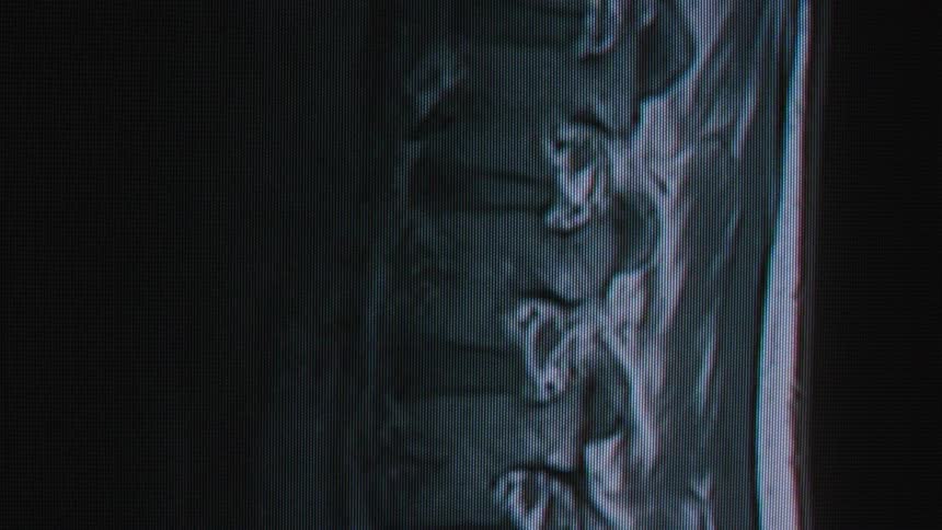 An animated MRI scan of a human lumbar spine loops on a pixelated computer monitor, revealing the vertebrae in detail