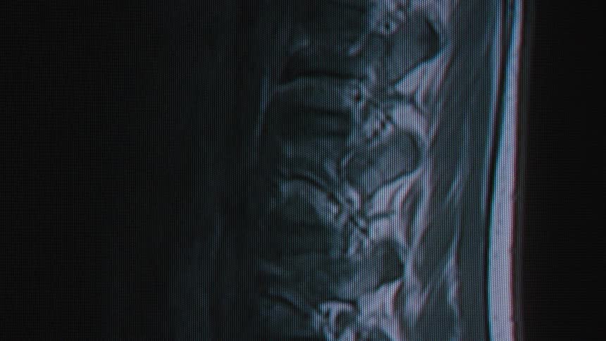 A detailed MRI of a human spine is displayed on a monitor with significant digital noise and glitch effects