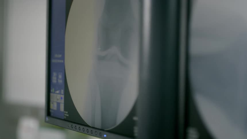 Medical equipment shows an image of a bone