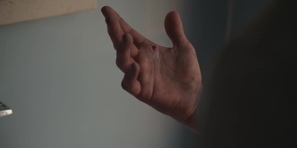 A hand is shown bleeding