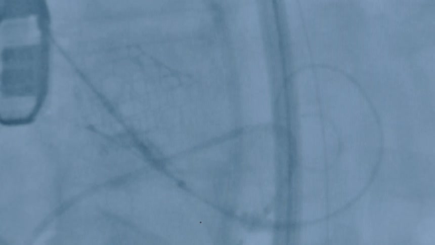 An x-ray shows a wire and tubing expanding and raising