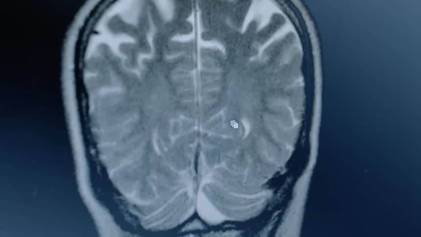 An brain scan is displayed on a computer