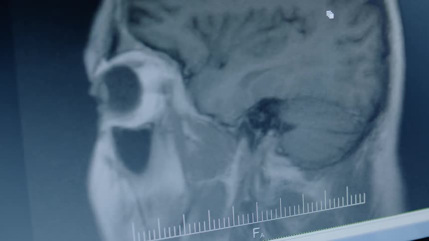 An brain scan is displayed on a computer