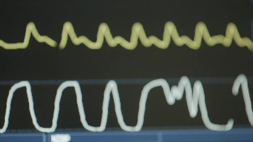 A view of a medical monitor with signals moving rapidly