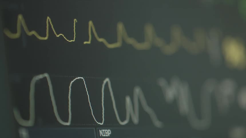 Close up of the monitor of an electrocardiogram machine