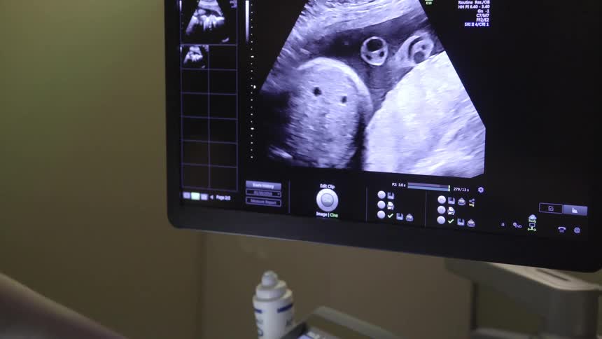 A white woman points and gestures at an ultrasound monitor
