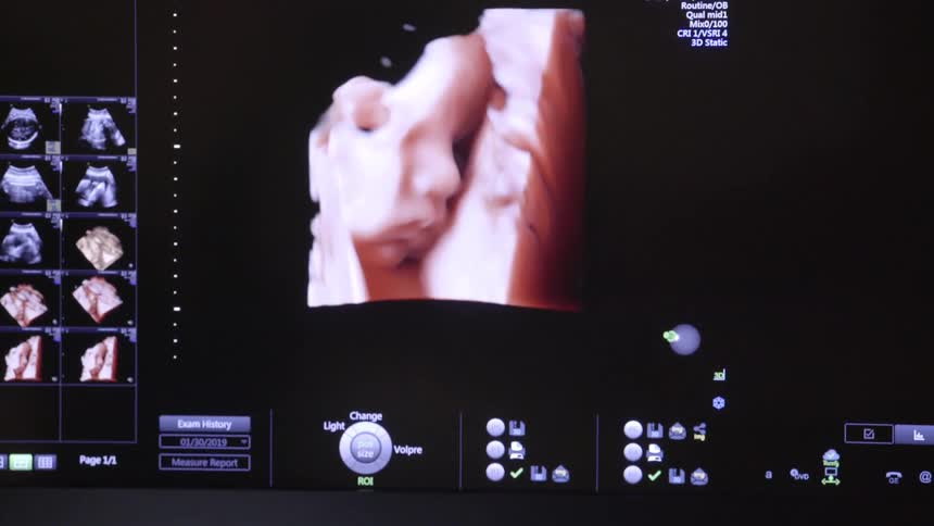 3d ultrasound of a baby on a tv screen