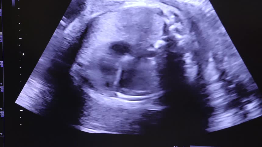 Ultrasound of beating heart