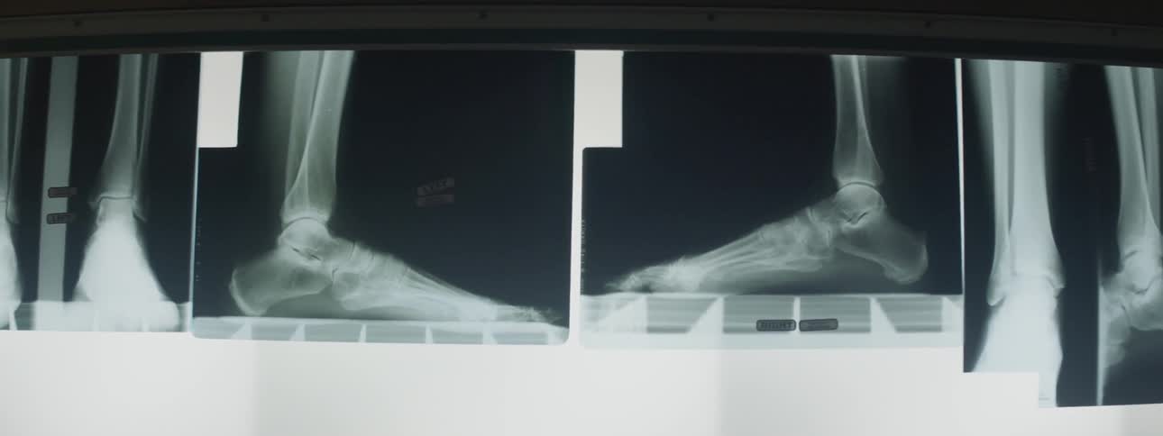 Xray pictures of a foot