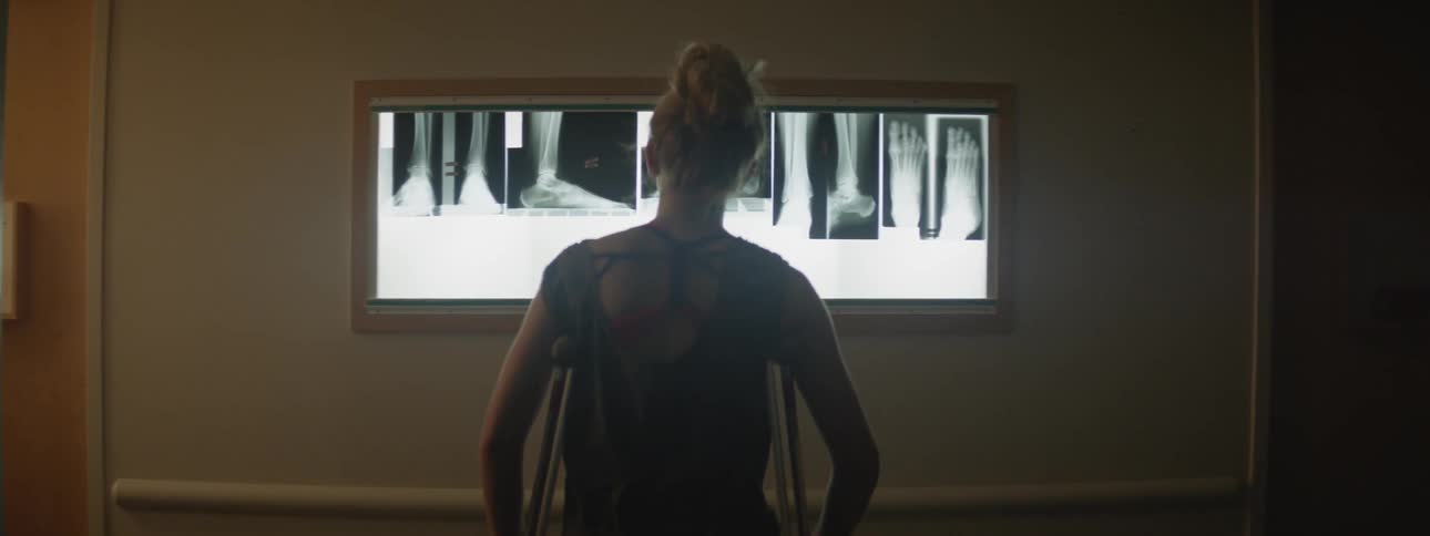 A young girl on crutches looks at x rays