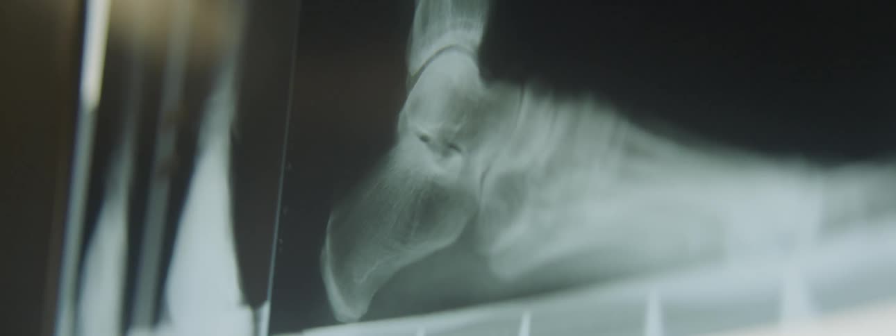 X rays of bones is displayed